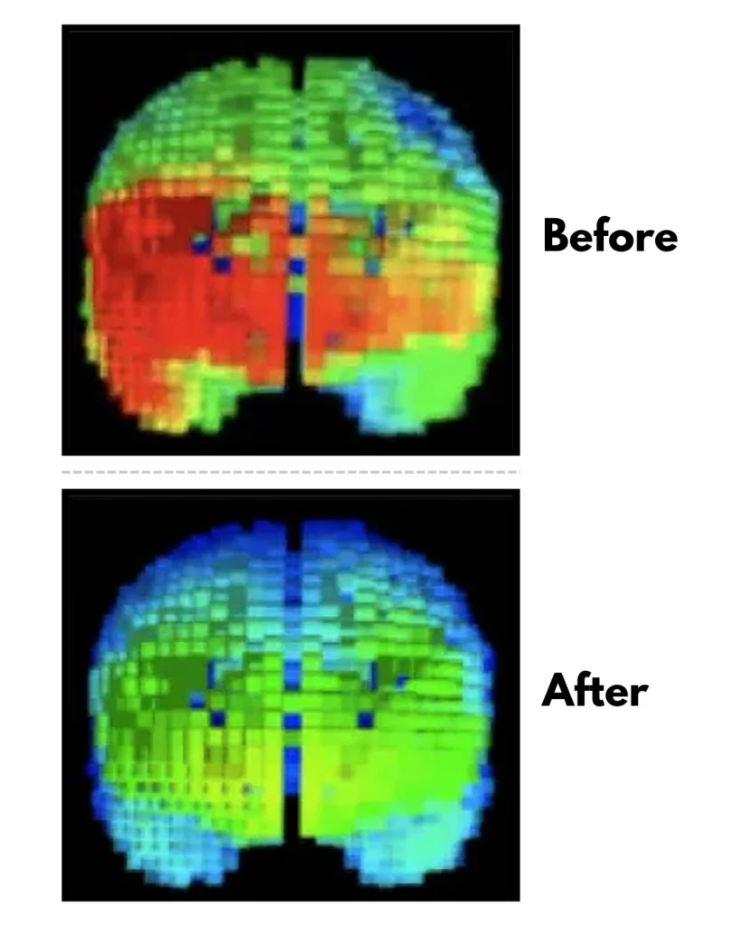 before after whole brain state